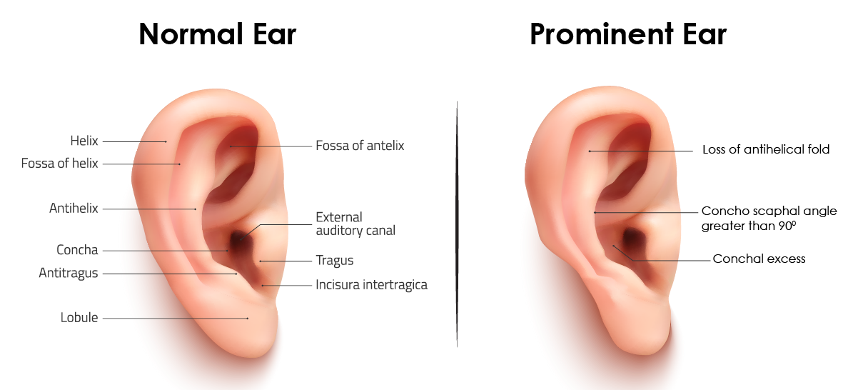 ear surgery cost in bangalore